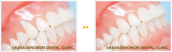 歯ぐきの移植イメージ